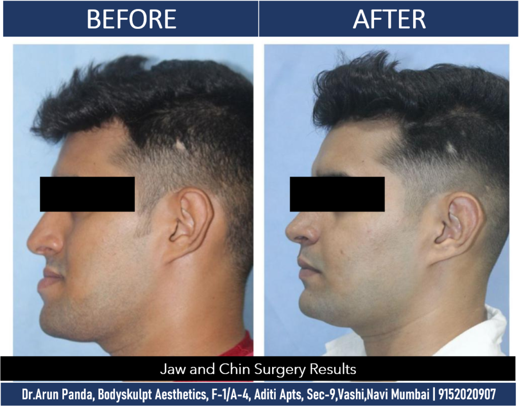 Enhance Your Profile: Jaw and Chin Surgery in Navi Mumbai