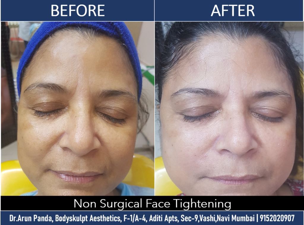 Effective Non-surgical Skin Tightening in Navi Mumbai