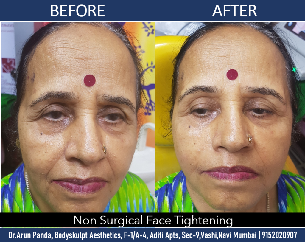 Navi Mumbai's Premier Non-surgical Skin Tightening Solution