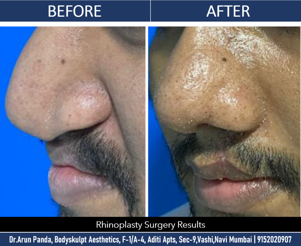 Expert Rhinoplasty Surgeon in Navi Mumbai for Beautiful Noses