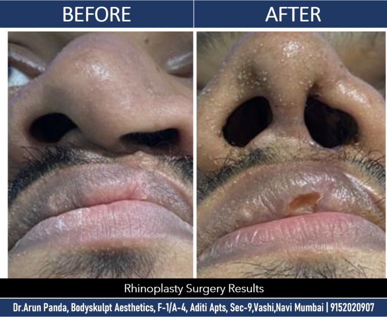 Enhance Your Nasal Aesthetics: Rhinoplasty Surgery in Navi Mumbai