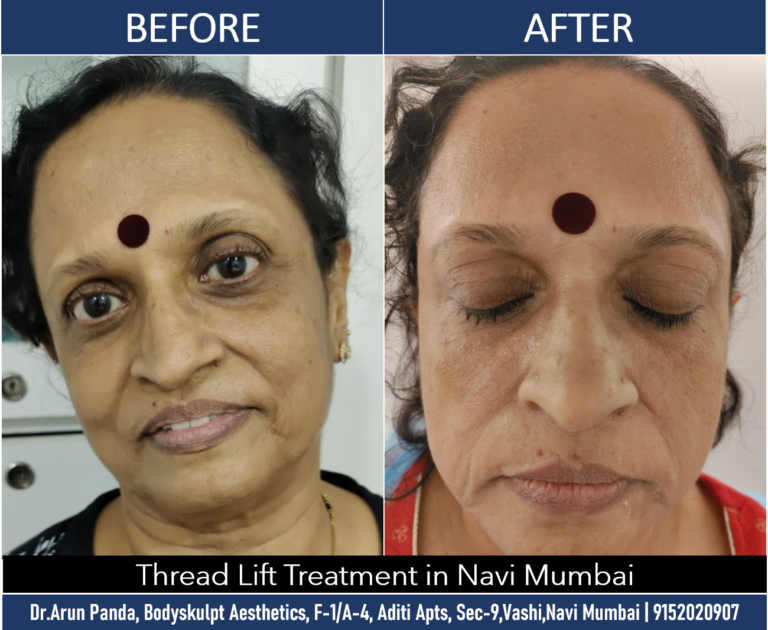 Threadlift Excellence: Treatment in Navi Mumbai