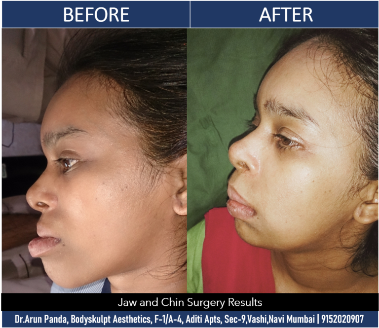 Sculpt Your Look: Jaw and Chin Surgery in Navi Mumbai